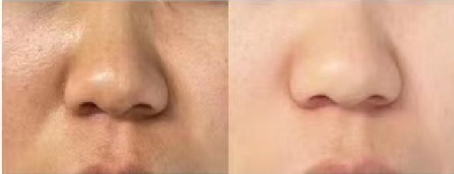 敏感&粉刺&毛孔